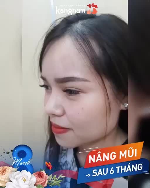 8/3, Tặng ưu đãi đến 35% Nâng mũi +Vô số quà tặng