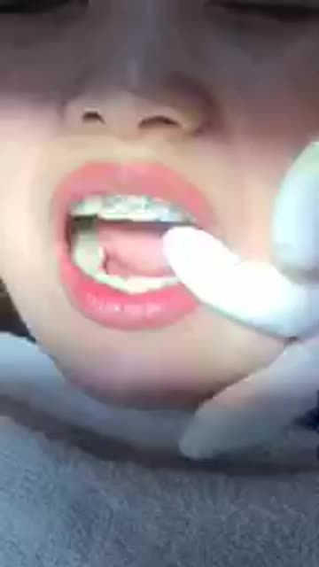 Bung lụa cho khách hàng 31t răng khấp khểnh sau 13 tháng niềng răng tại Nha Khoa Vân Anh.