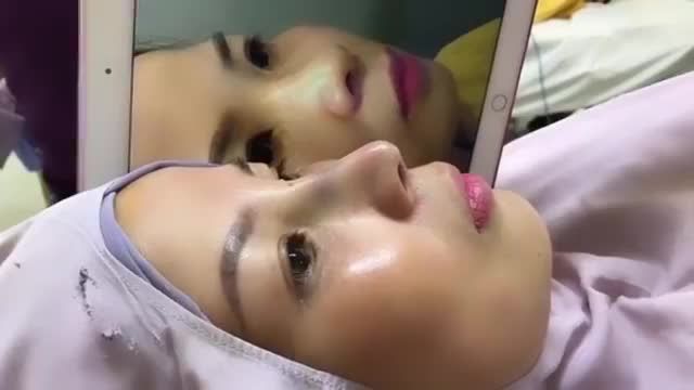 KẾT QUẢ NÂNG MŨI L- LINE ĐẸP XUẤT SẮC