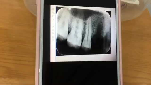 Cấy implant răng số 4 cho anh Giáp.