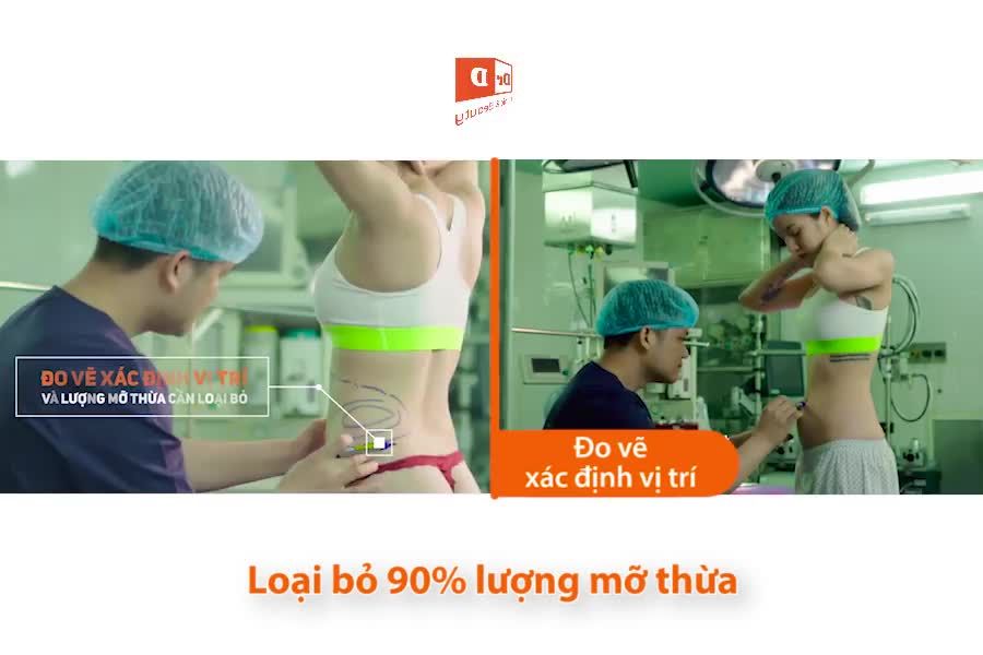 Hút mỡ Vaser Lipo - Đôi điều bạn nên biết