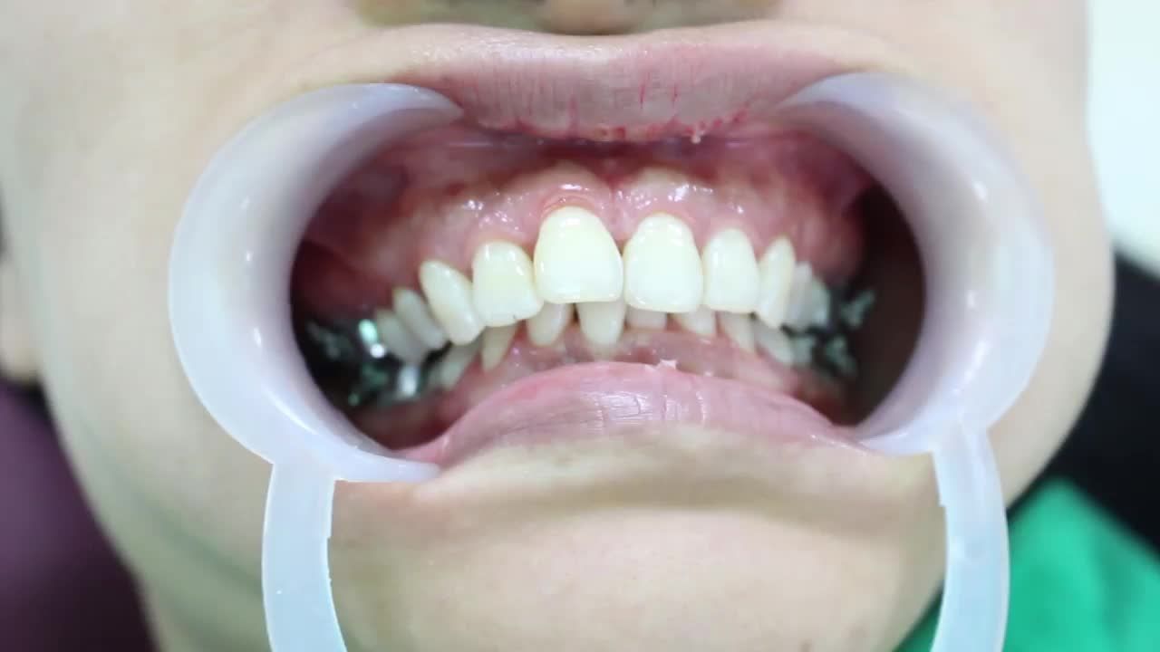 NIỀNG RĂNG MẮC CÀI PHA LÊ - TƯỞNG KHÓ MÀ DỄ