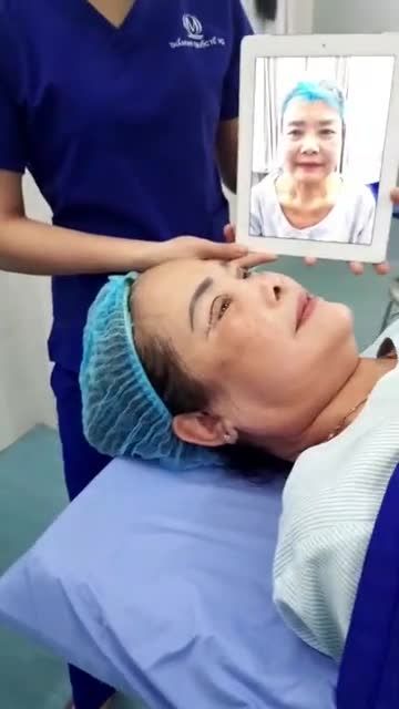 Sự thay đổi diện mạo đến bất ngờ sau cắt mí baby eys 6D nhà VQ!