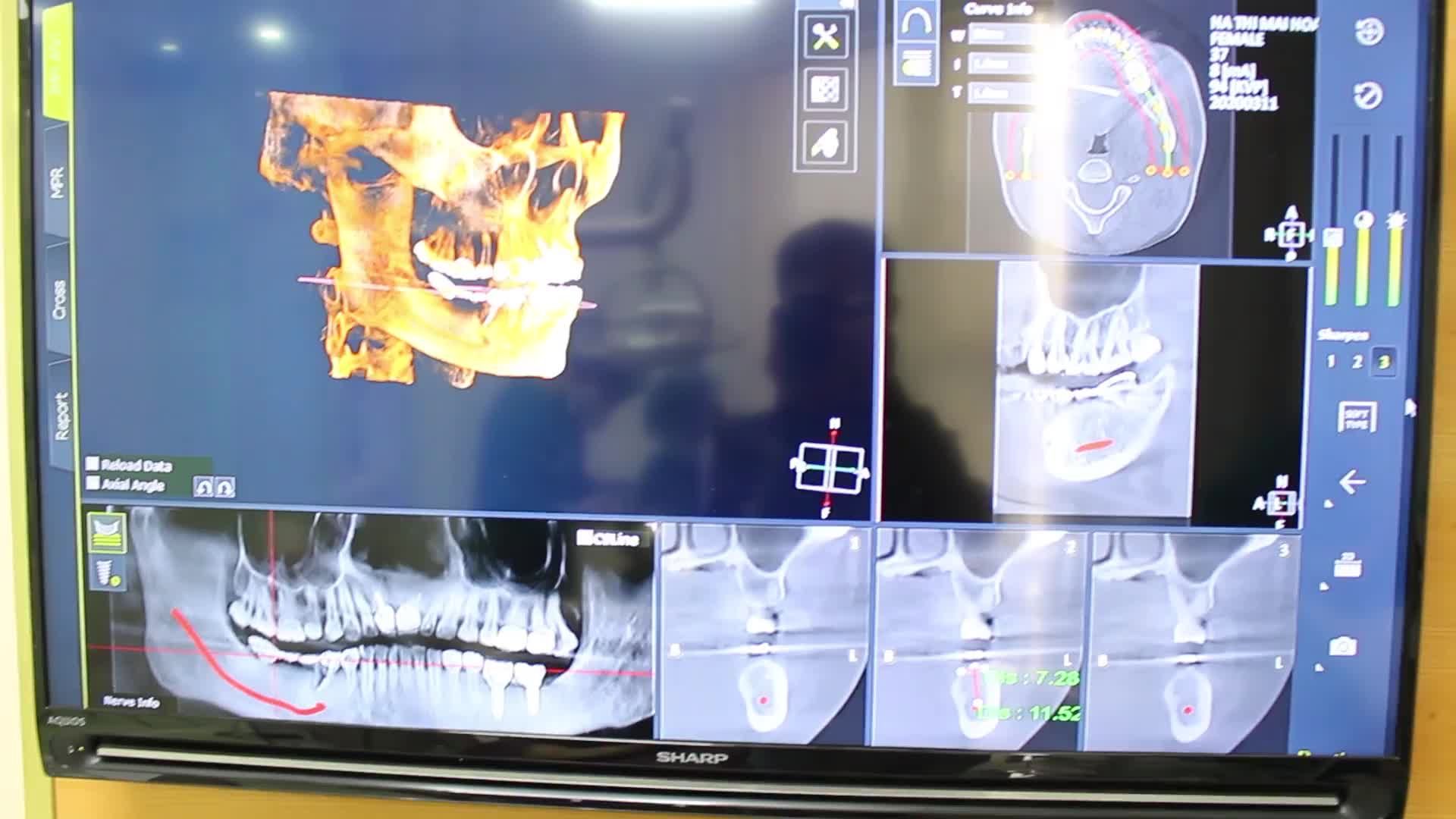 CẤY GHÉP IMPLANT - TRỒNG MỘT LẦN DÙNG TRỌN ĐỜI