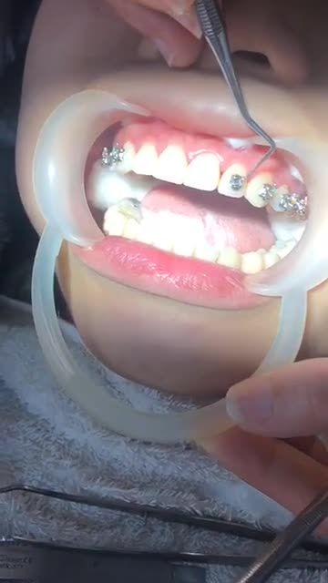 GẮN MẮC CÀI NIỀNG RĂNG ĐIỀU TRỊ RĂNG HÔ tại Nha Khoa Vân Anh !