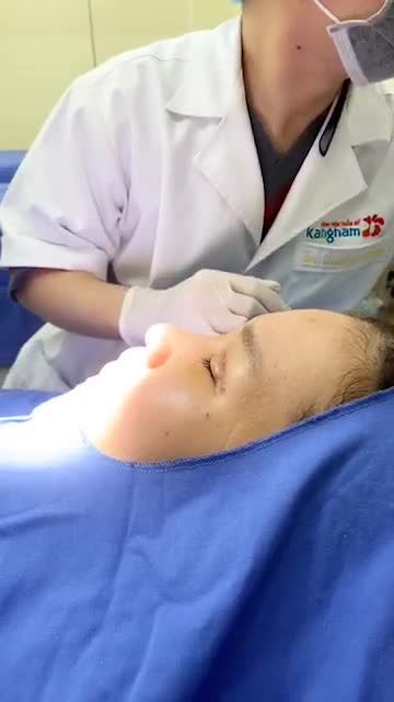 Cắt chỉ mí - SAU 5 NGÀY Nhẹ nhàng như không