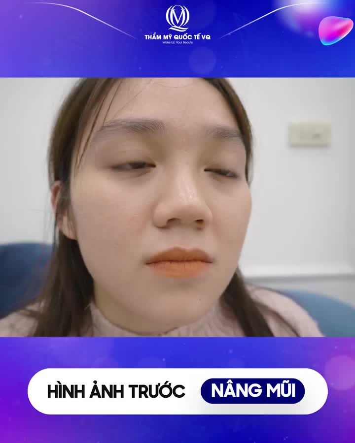 Mũi Softline sau 9 ngày thực hiện tại VQ