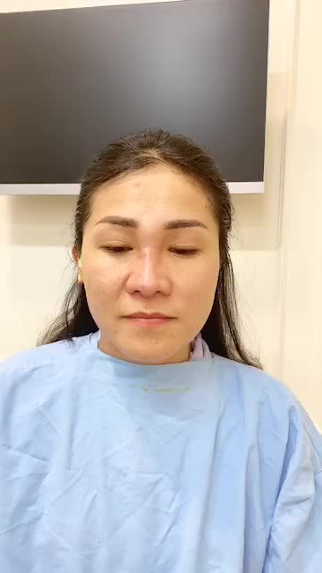 Nâng mũi siêu cấu trúc form tự nhiên