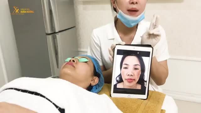 STRESS VÌ LÀN DA "PHỦ KÍN" NÁM, KH ĐẾN XUÂN HƯƠNG ĐIỀU TRỊ MELAS PICOSURE VÀ KẾT QUẢ KHIẾN AI CŨNG BẤT NGỜ