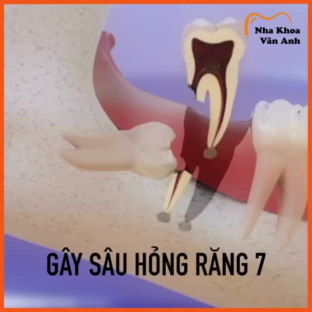 5 HẬU QUẢ KHÔN LƯỜNG KHI TRÌ HOÃN NHỔ RĂNG SỐ 8
