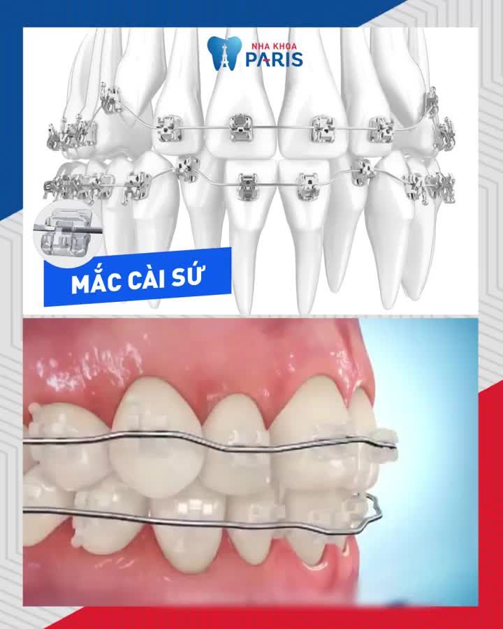 RĂNG KHẤP KHỂNH, THƯA - HÔ, MÓM, MỌC LỆCH‼