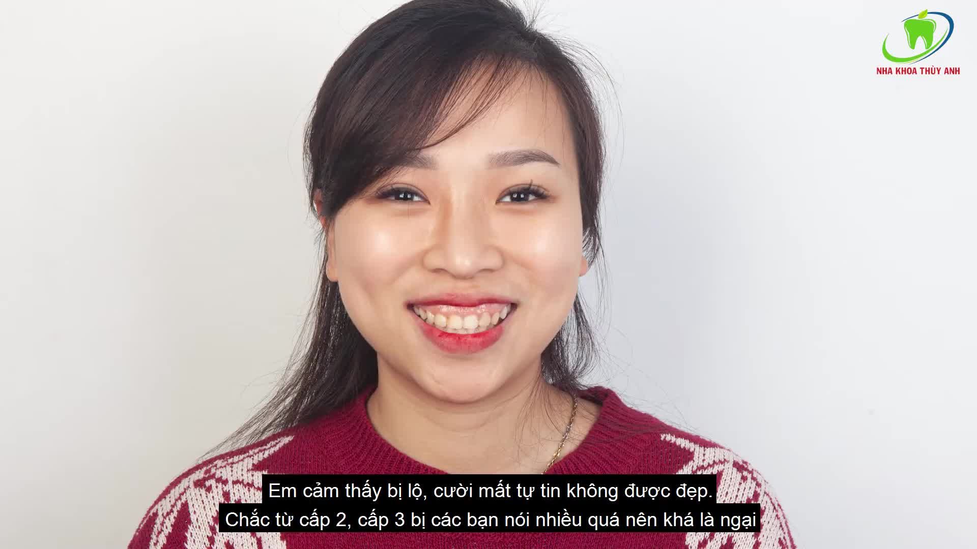 SỞ HỮU NỤ CƯỜI TỰ TIN SAU NHIỀU NĂM THÁNG BỊ CHE ĐẬY BẰNG PHƯƠNG PHÁP ĐIỀU TRỊ CƯỜI HỞ LỢI TẠI NHA KHOA THÙY ANH