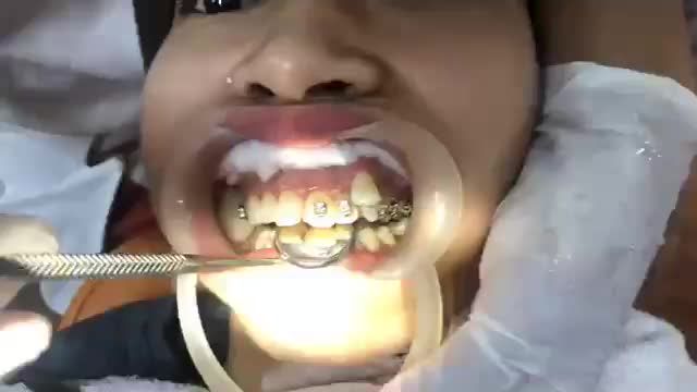 GẮN MẮC CÀI TẠI NHA KHAO VÂN ANH