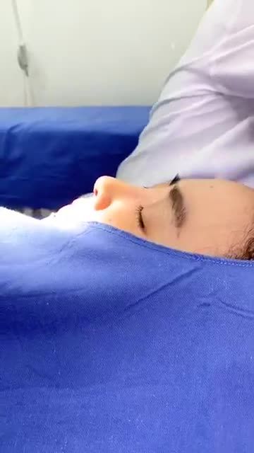 Nâng mũi cấu trúc 4D - Cận cảnh quy trình cắt chỉ mũi sau 10 ngày nâng mũi! Dáng mũi khi nằm ấn tượng lắm đúng không?
