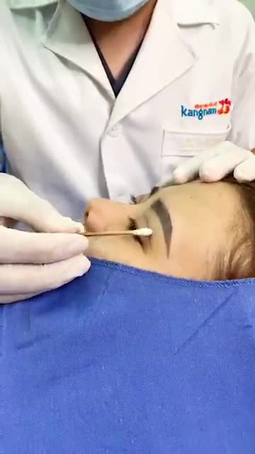 Mí mắt đẹp sau 5 ngày phẫu thuật. Trực tiếp quy trình cắt chỉ mí tại Kangnam