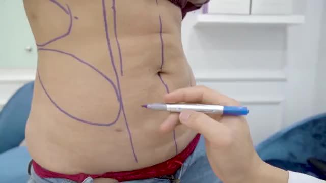 Bác sĩ nói gì về CA HÚT MỠ BỤNG BODY JET đầu tiên trong ngày hôm nay ? Mời mọi người đón xem!