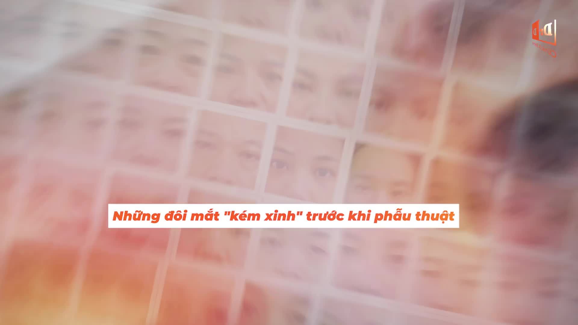 Cắt mí Elite Eyes - Đẹp hoàn hảo sau 30 phút!