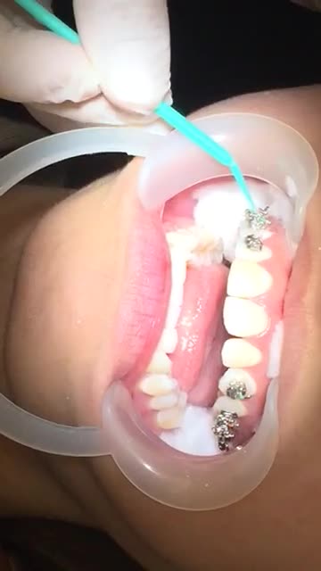 GẮN MẮC CÀI NIỀNG RĂNG ĐIỀU TRỊ RĂNG HÔ tại Nha Khoa Vân Anh !