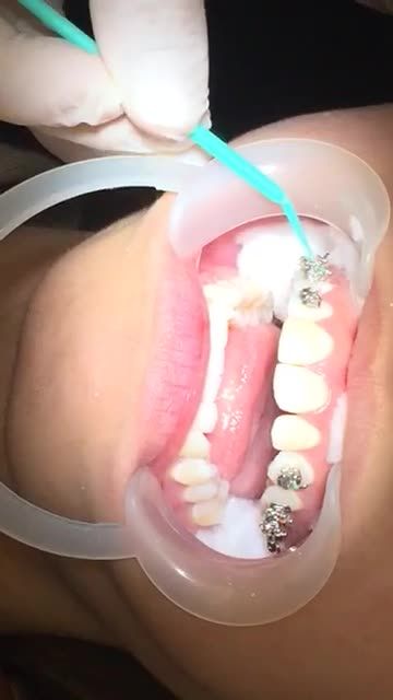 GẮN MẮC CÀI NIỀNG RĂNG ĐIỀU TRỊ RĂNG HÔ tại Nha Khoa Vân Anh !