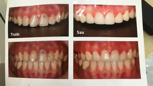 Lắp răng sứ thẩm mỹ tại Nha Khoa Thuỳ Anh.