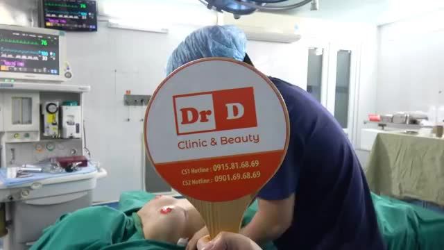 Siêu combo Treo sa trễ độ 2 ở đường quầng vú phải và kết hợp với nâng n.g.ự.c sử dụng túi ngực Moltiva Nano Chip size 300cc