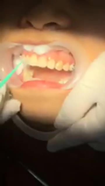 GẮN MẮC CÀI NIỀNG RĂNG ĐIỀU TRỊ RĂNG HÔ tại Nha Khoa Vân Anh !!!