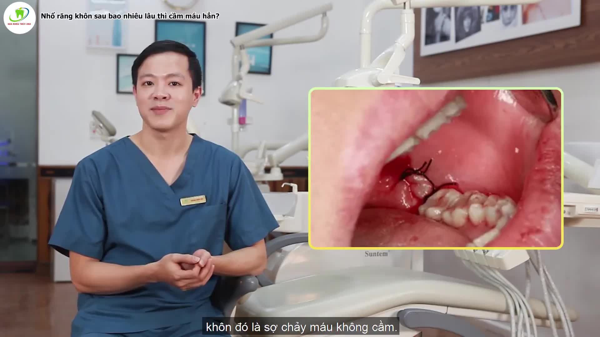 NHỔ RĂNG KHÔN SAU BAO LÂU THÌ CẦM MÁU?