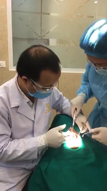 Nhổ răng khôn siêu cong siêu khó ! Nhổ bằng công nghệ máy siêu âm R38 Khách hàng : Xuân Kiên ( Nam Định )