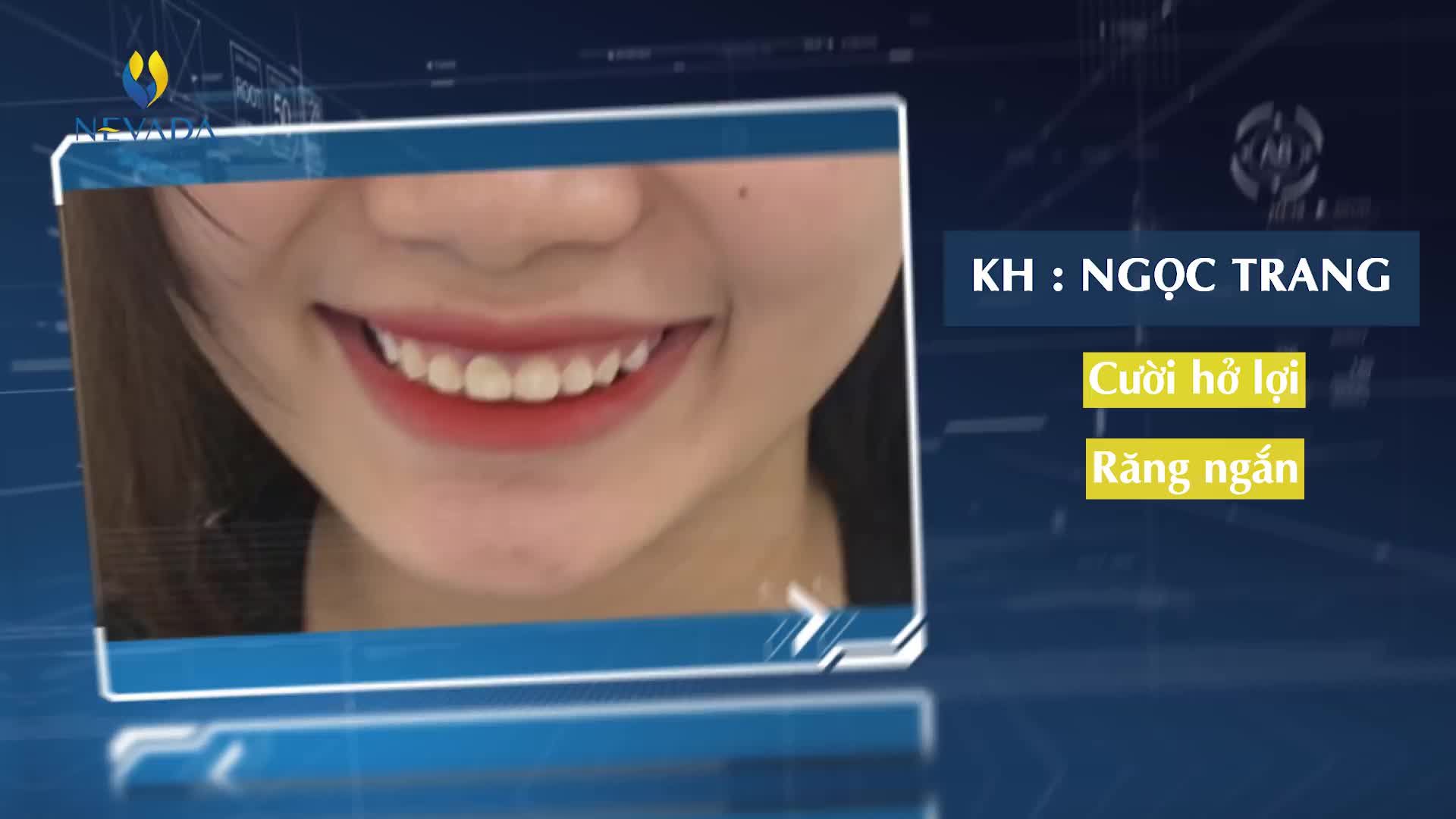 RĂNG NGẮN - CƯỜI HỞ LỢI: ĐÂU MỚI LÀ GIẢI PHÁP HOÀN HẢO