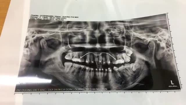 Nhổ răng khôn mọc lệch 90 độ hỗ trợ chỉnh nha.