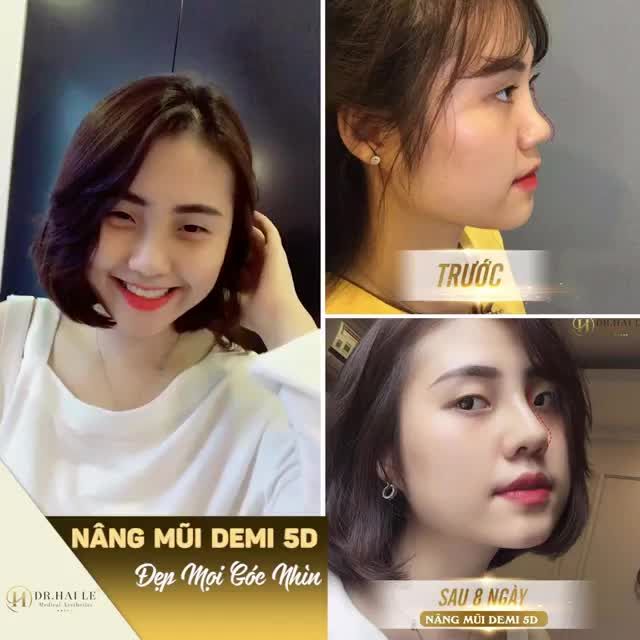 NÂNG MŨI DEMI 5D TẠI DR.HẢI LÊ‼️