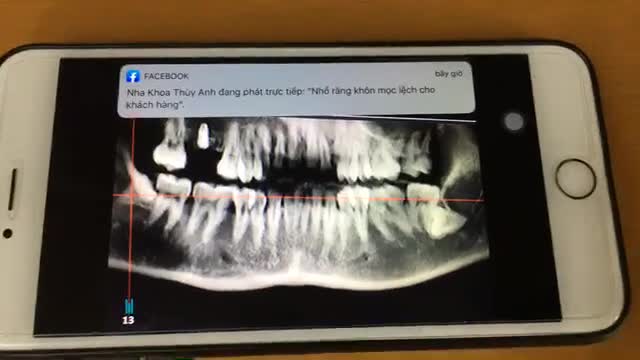 Nhổ răng khôn mọc lệch cho khách hàng.