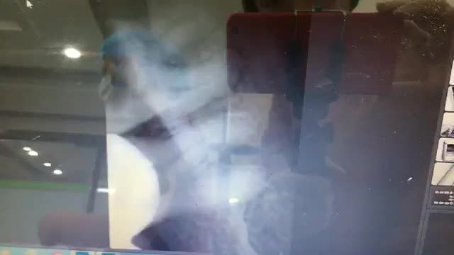 Case nhổ răng khôn đầu tiên của ngày chủ nhật tại Nha Khoa Thuỳ Anh.