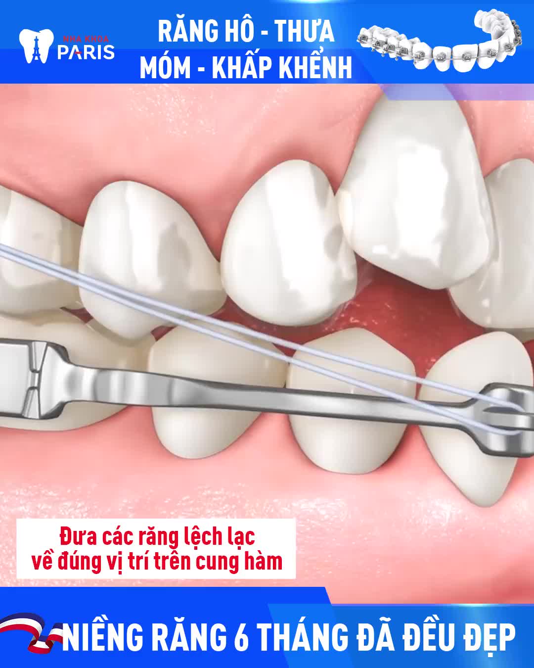 RĂNG HÔ - THƯA - MÓM - KHẤP KHỂNH MẤT TỰ TIN THAY ĐỔI NỤ CƯỜI NHỜ NIỀNG RĂNG 3D SPEED