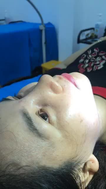 Khách hàng đến tái khám cắt chỉ nâng mũi sau 10 ngày nhe cả nhà