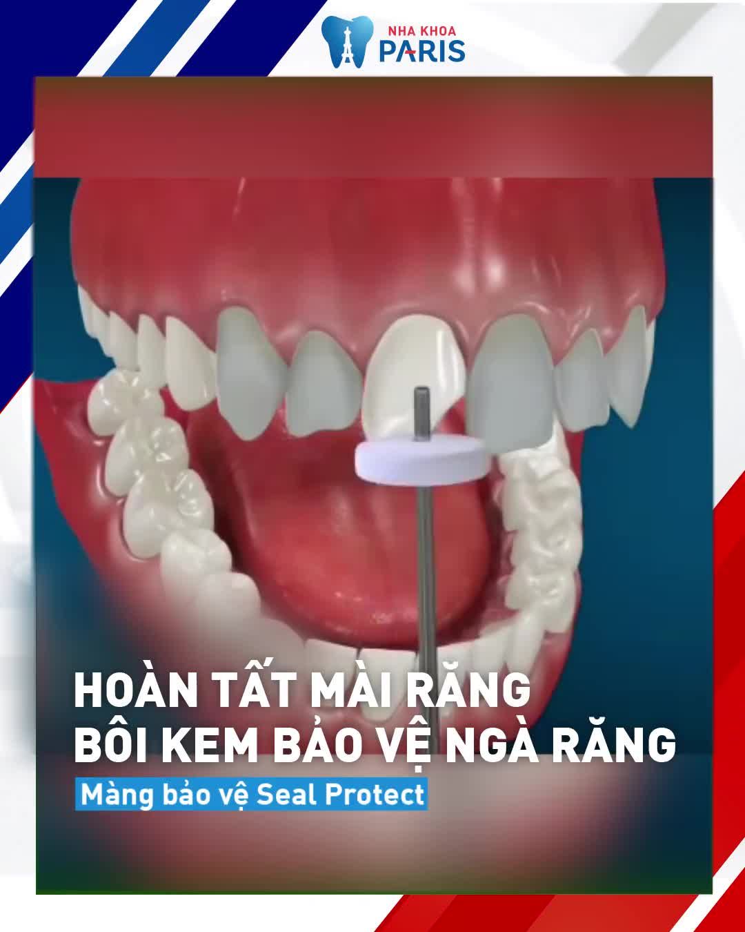 SỨT MẺ THƯA KẼ GÃY VỠ MẤT RĂNG