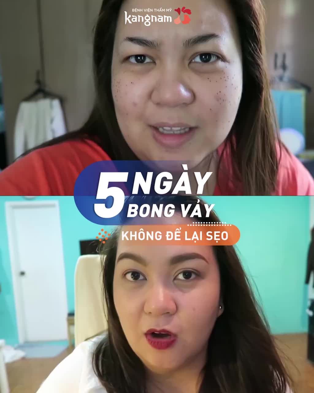 Đánh bật mụn thịt tận gốc rễ  Chỉ 40 PHÚT