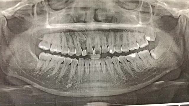 Nhổ răng khôn 38 ngầm lệch 90 độ, 28 lệch 45 độ cho chị Thảo tại Nha Khoa Thuỳ Anh.