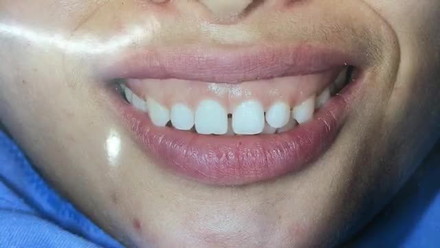 Case điều trị cười hở lợi cho chị Nhạn tại Nha Khoa Thuỳ Anh.