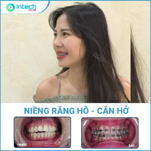 BIẾN HÓA RĂNG HÔ, CẮN HỞ ĐỀU ĐẸP NHỜ NIỀNG RĂNG - Thành quả sau 1 năm
