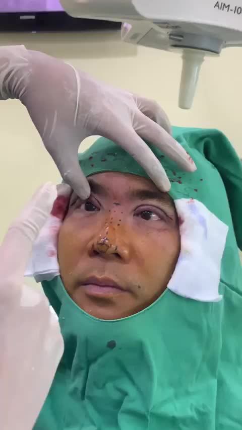 Ca Nam này mình khá thích, trước và sau khi Nâng mũi và Cắt mí trông khác hẳn luôn. Cả nhà chờ sau 1 tháng nhé