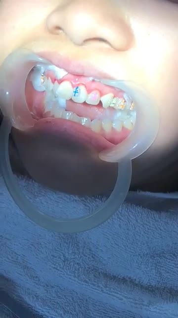 GẮN MẮC CÀI NIỀNG RĂNG ĐIỀU TRỊ RĂNG KHẤP KHỂNH tại Nha Khoa Vân Anh !!!