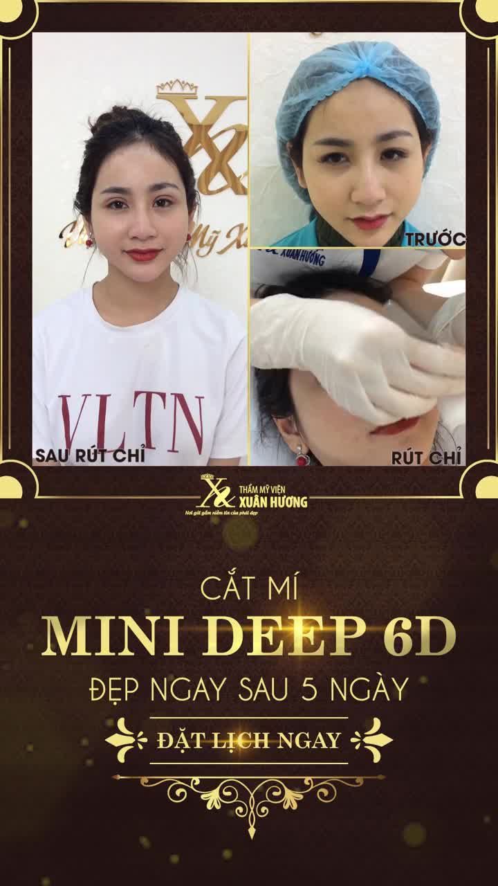 MÍ ĐẸP CHỈ SAU 5 NGÀY CẮT MÍ MINIDEEP 6D TẠI TMV XUÂN HƯƠNG