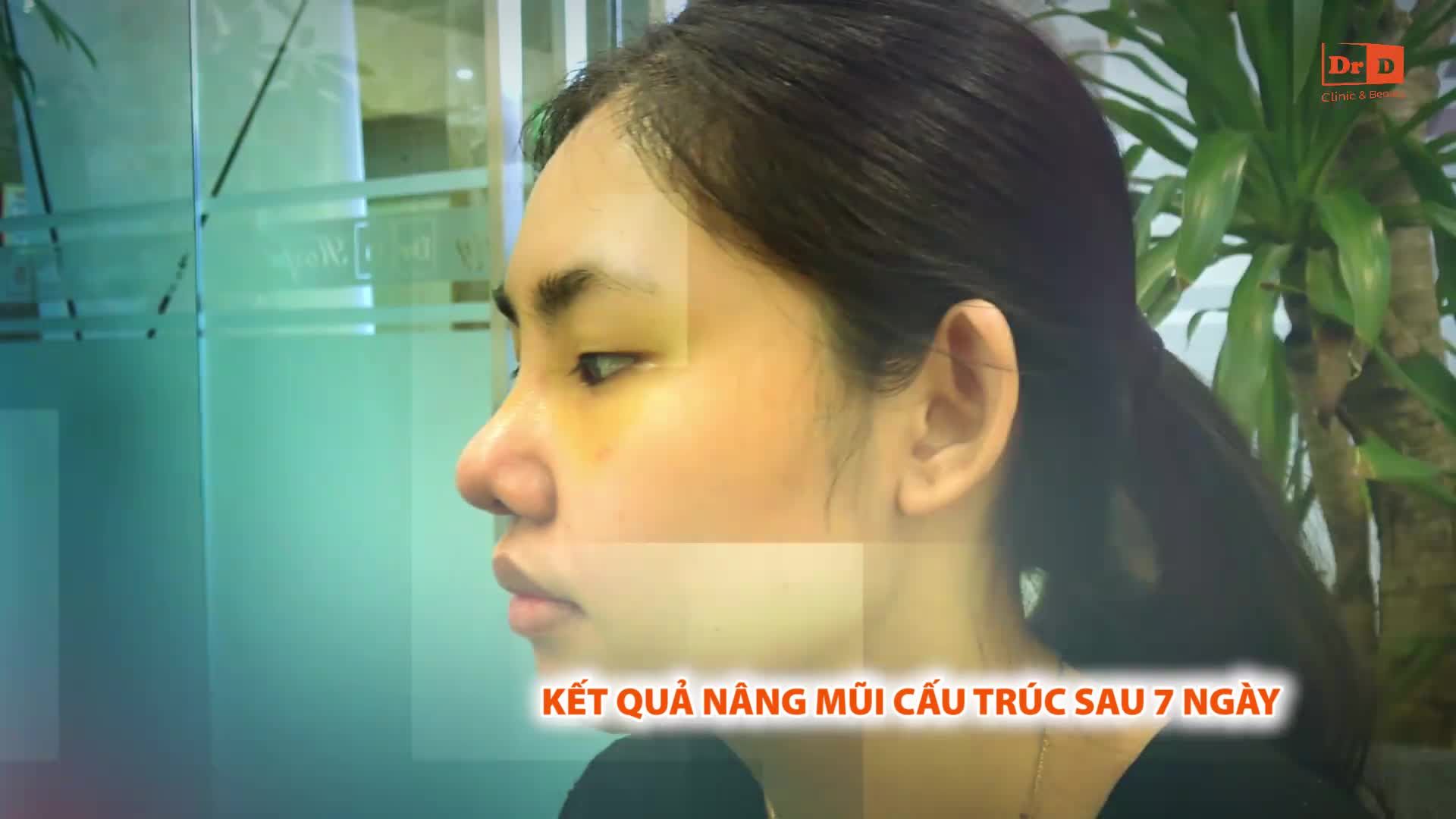NÂNG MŨI CẤU TRÚC - THAY ĐỔI HOÀN TOÀN GƯƠNG MẶT