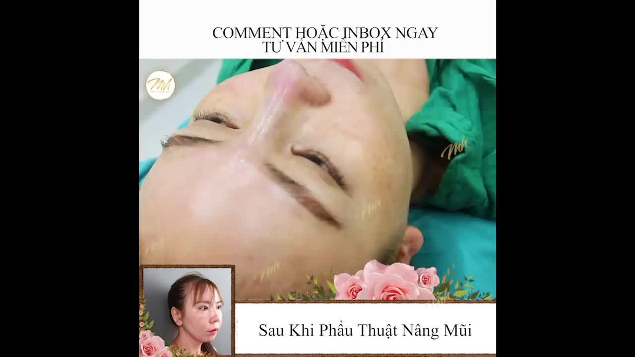 TÌNH DUYÊN LẬN ĐẬN - NÂNG MŨI ĐỔI VẬN