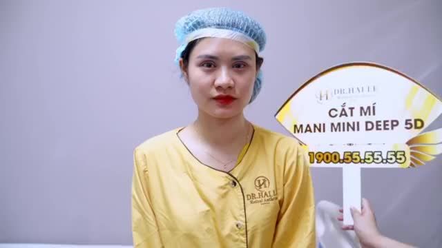 Kết quả đẹp xuất sắc sau 30 phút cắt mí Mani Mini Deep 5D cho bạn gái. KH chia sẻ "Cắt mí chỉ tin tưởng VTM Dr.Hải Lê"