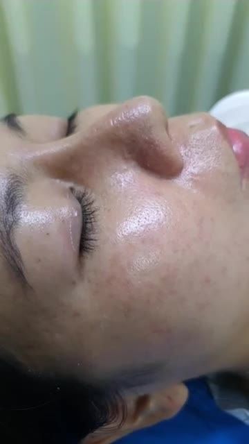 Nâng mũi bán cấu trúc Dáng Sline kết hợp Lline Sau 11 ngày Quá đẹp cho em gái Vũng Tàu