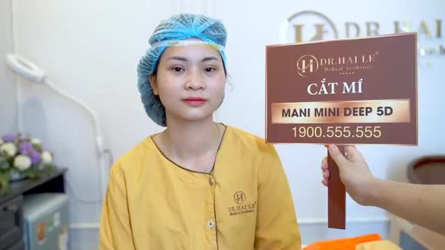 Kết quả đẹp xuất sắc sau 30 phút cắt mí Mani Mini Deep 5D cho bạn gái. KH chia sẻ "Cắt mí chỉ tin tưởng VTM Dr.Hải Lê"