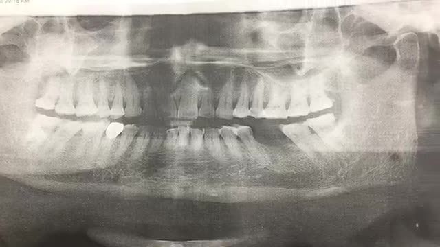 Cấy implant tại Nha Khoa Thuỳ Anh.