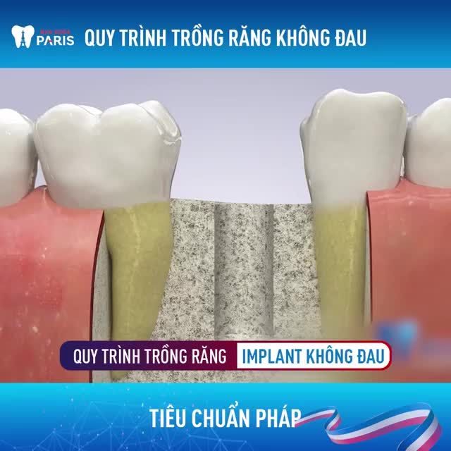 QUY TRÌNH THAY THẾ RĂNG MẤT VỚI CÔNG NGHỆ 4.0